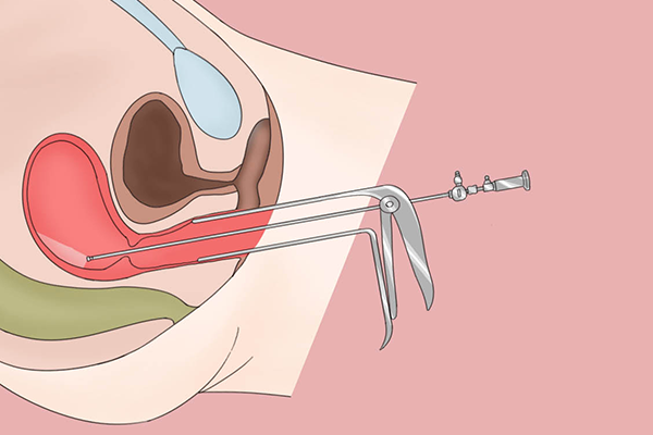 宫腔镜检查疼吗