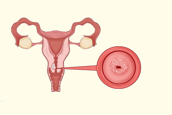 宫颈癌的最早期症状