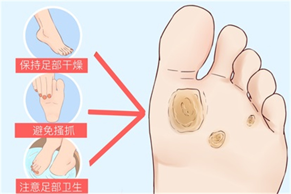 鸡眼怎么形成