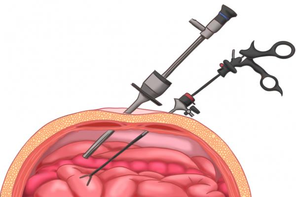 腹腔镜手术的危害大吗